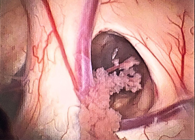 Digital Neuro - ventricle